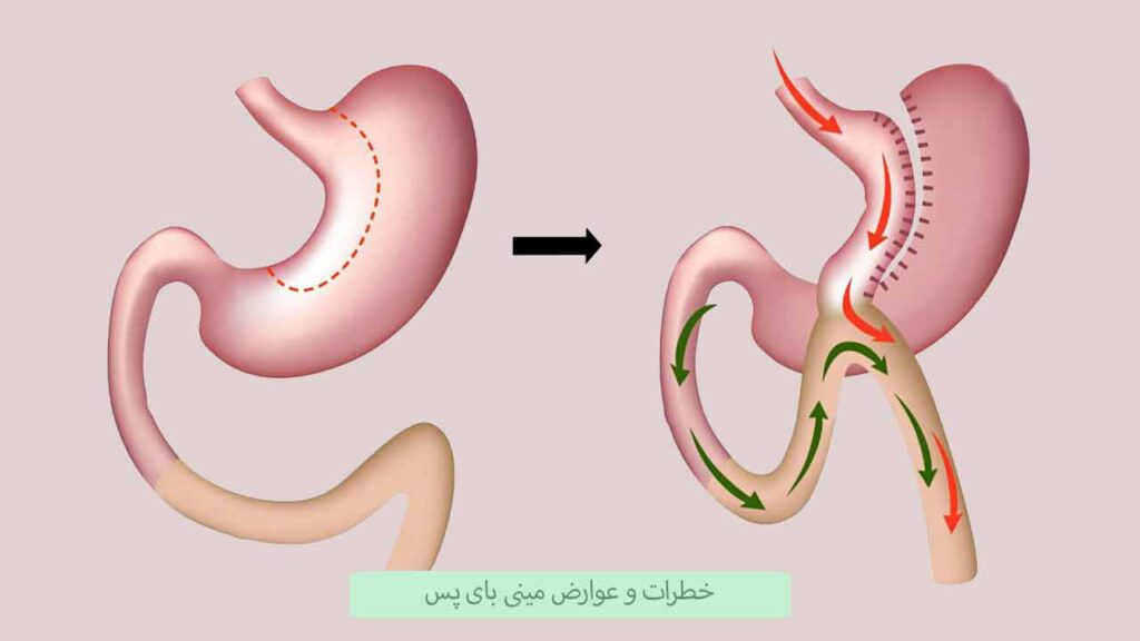 خطرات و عوارض مینی بای پس