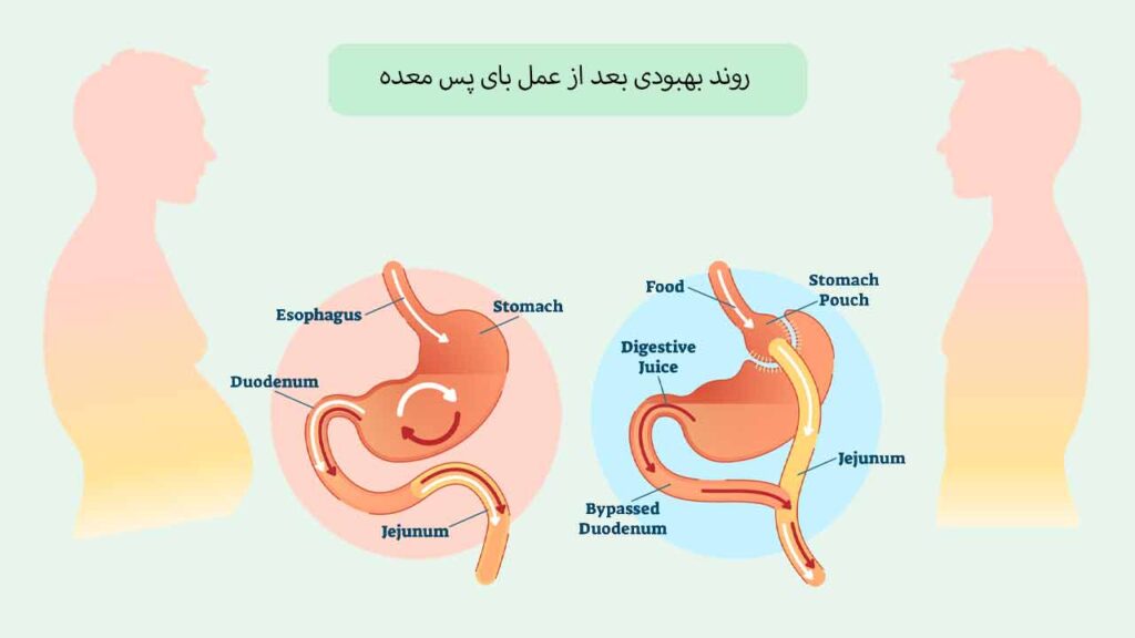 روند بهبودی بعد از عمل بای پس معده