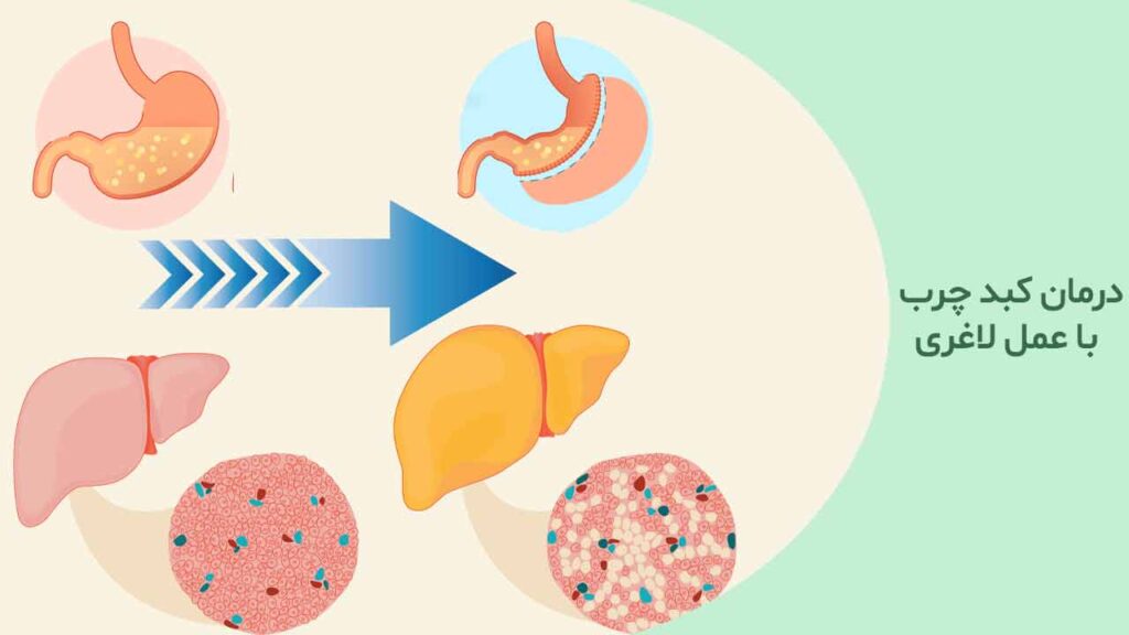درمان کبد چرب با عمل لاغری