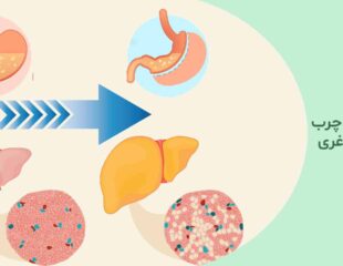 درمان کبد چرب با عمل لاغری