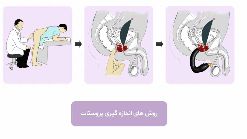 روش های اندازه گیری پروستات