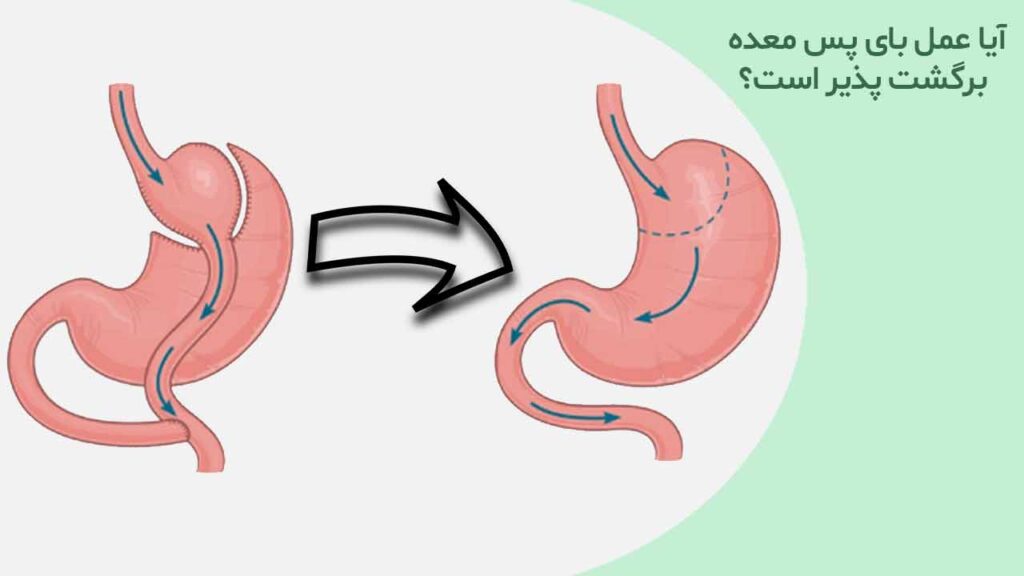 آیا عمل بای پس معده برگشت پذیر است؟