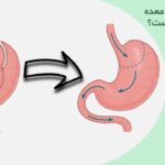 آیا عمل بای پس معده برگشت پذیر است؟