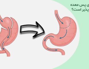 آیا عمل بای پس معده برگشت پذیر است؟