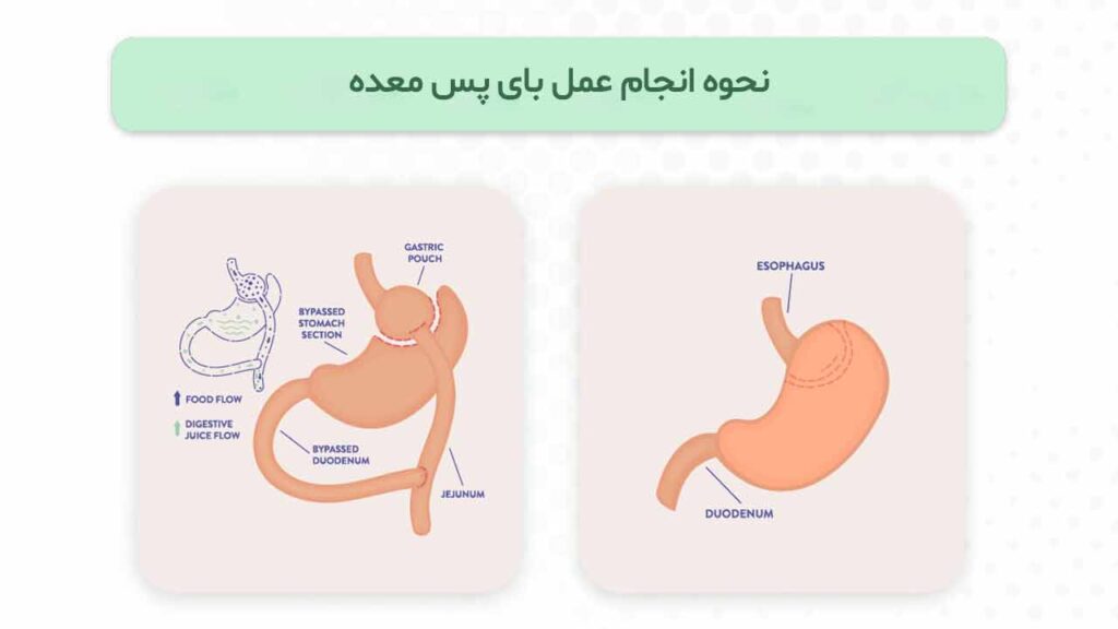 نحوه انجام عمل بای پس معده