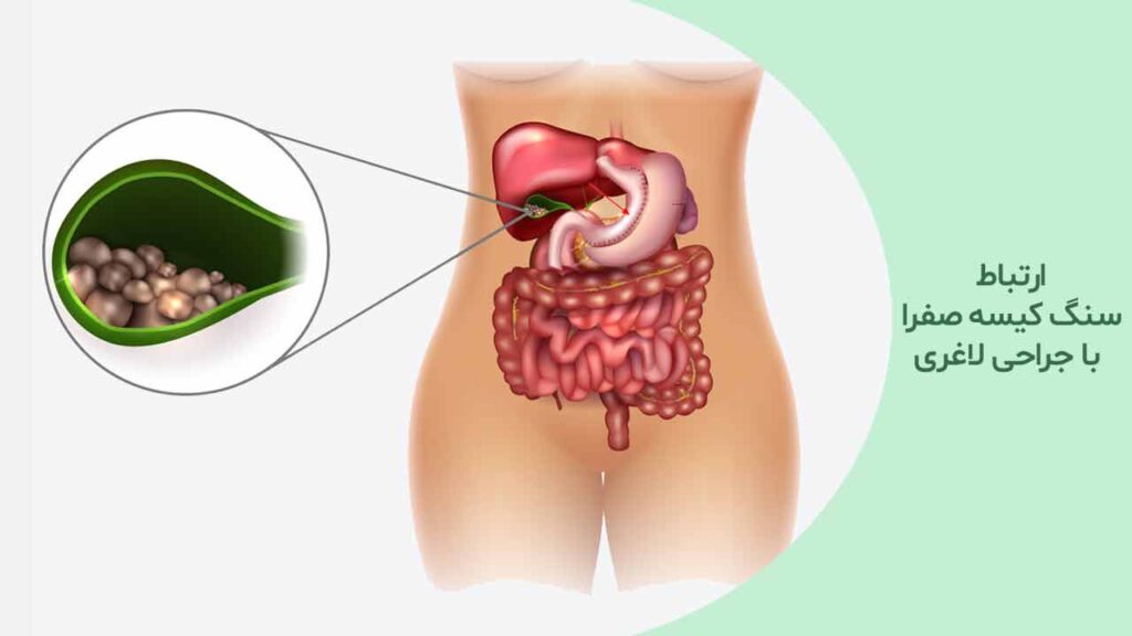 ارتباط سنگ کیسه صفرا با جراحی لاغری