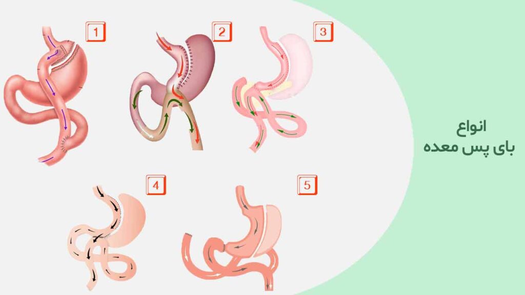 انواع بای پس معده
