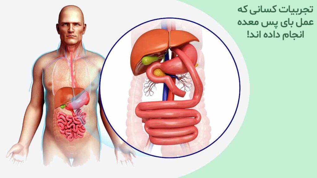 تجربیات کسانی که عمل بای پس معده انجام داده اند