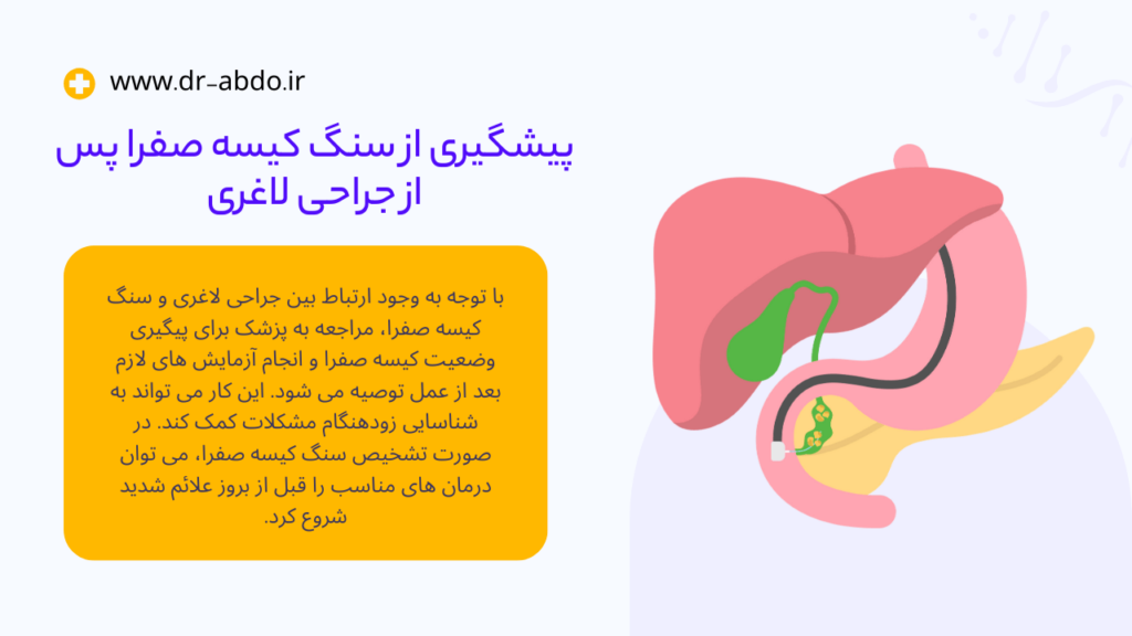 پیشگیری از سنگ کیسه صفرا پس از جراحی لاغری