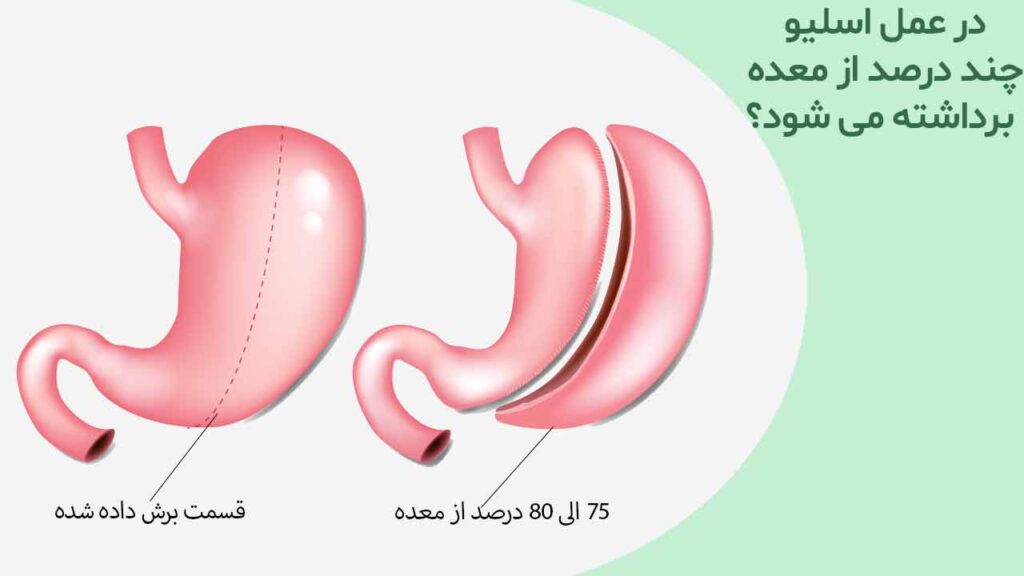 در عمل اسلیو چند درصد از معده برداشته می شود