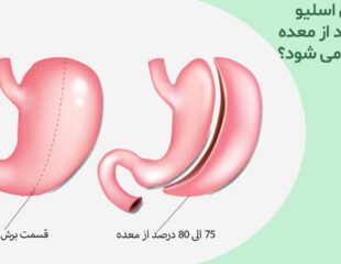 در عمل اسلیو چند درصد از معده برداشته می شود